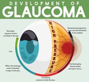 Novel Drug For Glaucoma Treatment | BIRAD - Research And Development Co ...